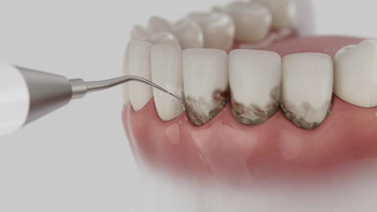Trusted Wisdom Tooth Removal service in Georgetown, GA - Dentist Open Now